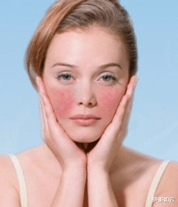 伊美如云|酸类产品用多了,会出现红血丝吗?