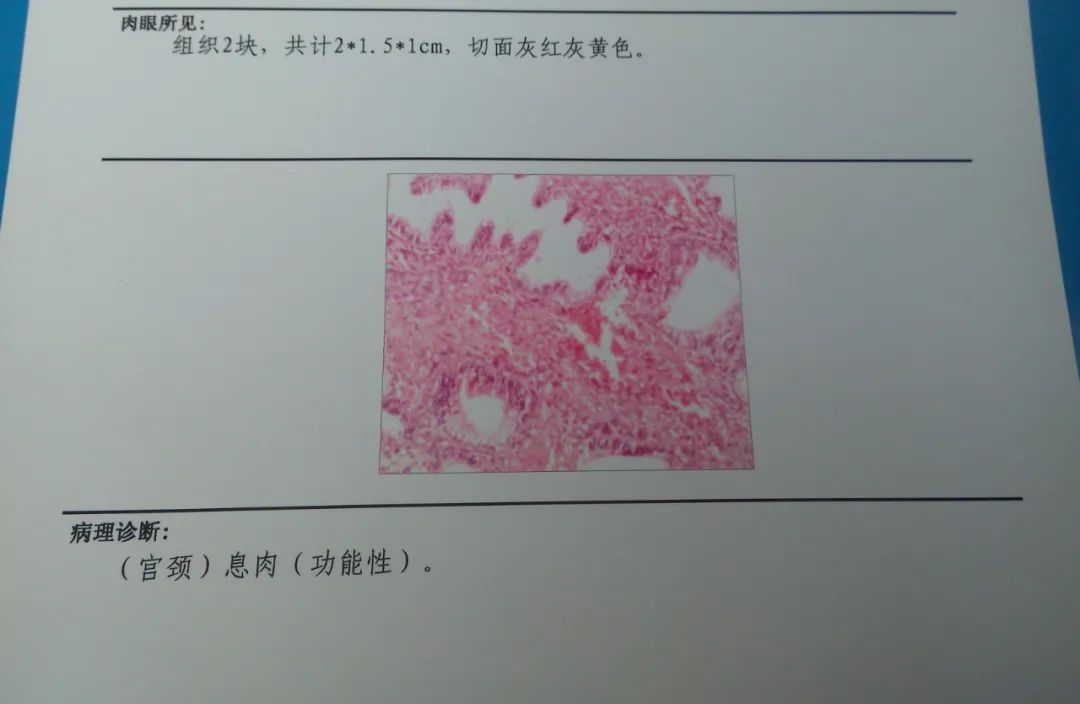 金兰中医学社 一切息肉与囊肿，用这个4味药的中医方子，可去死肌，蚀恶肉