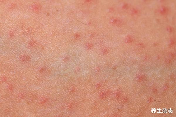 肝癌|一天两碗粥，32岁农民工确诊肝癌，医生：或是肝癌的“加速器”，趁早扔