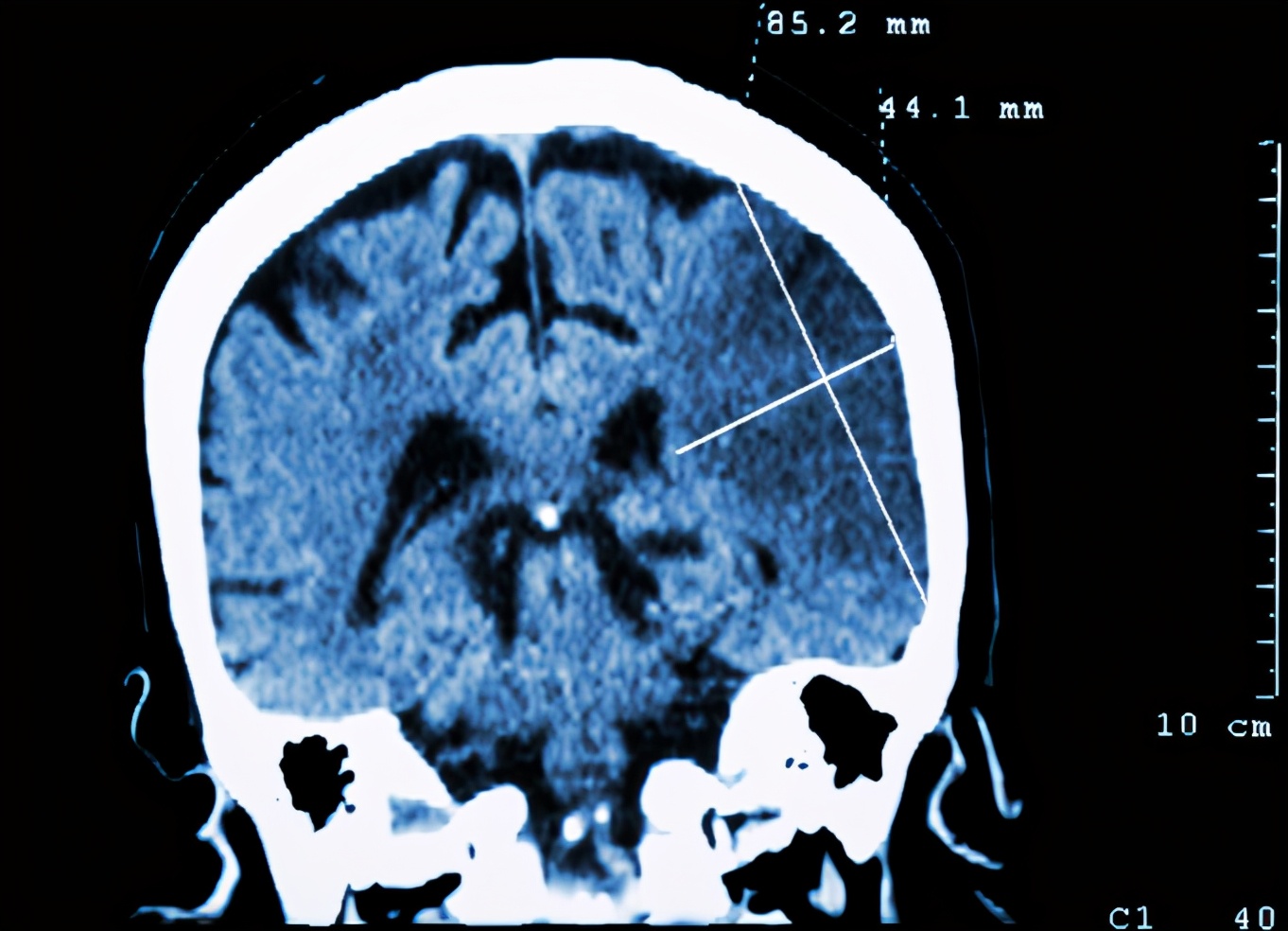 脑梗|宝妈脑梗入院，最终半身不遂，医生：常吃1种粗粮，等于吃肥肉