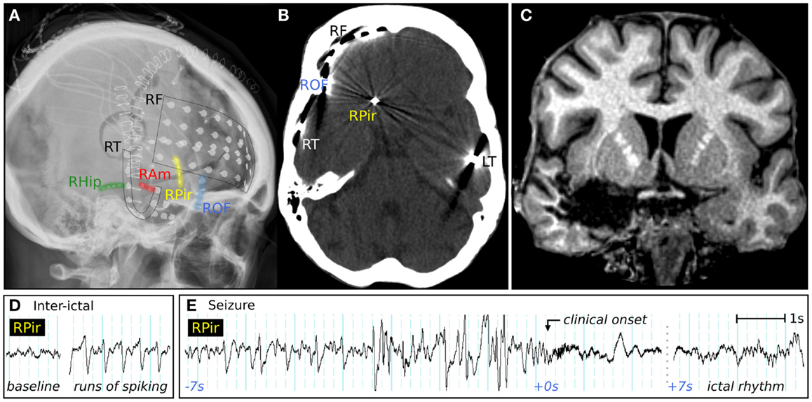 甲状腺结节|66岁还没出现脑梗，是什么水平？医生：恭喜您，已经及格了