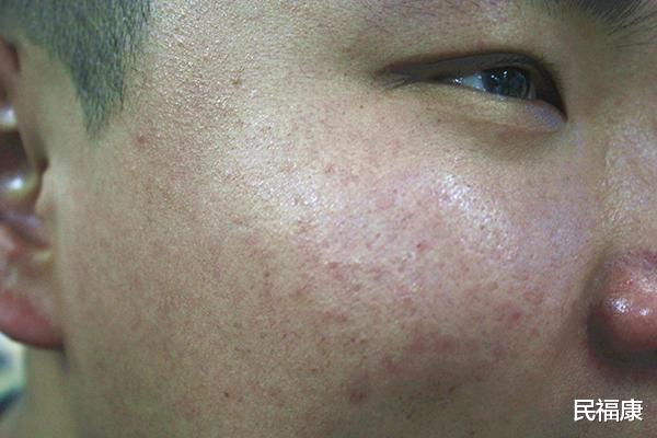 维生素b12|人体缺乏维生素B12会有哪些表现? 长期吃素为何还是缺少? 需要注意