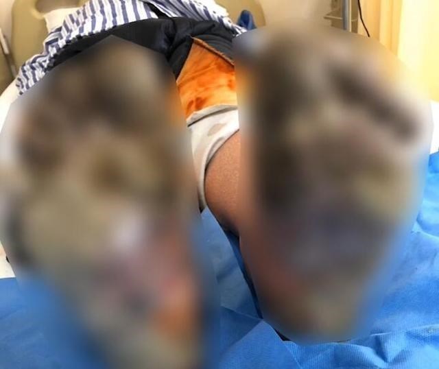 ACG分享站 自讨苦吃!醉酒男子雨夹雪中门外露宿12小时,10个脚趾被冻截肢