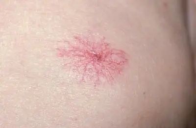 肝癌|身上出现“三红二痛一痒”，或许是肝癌早期信号！抓住一个能救命