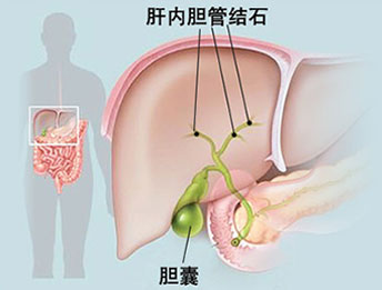 海绵宝宝会唱歌|哪些人患上肝胆管结石?