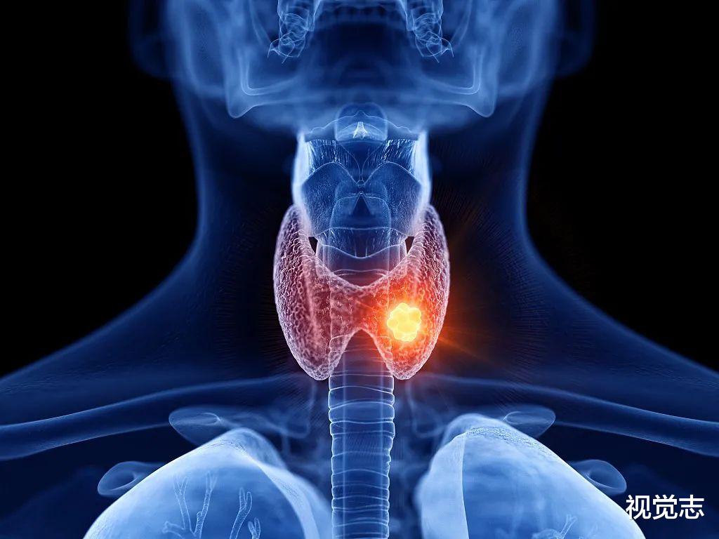 视觉志|拿到你的体检报告，小心「结节」二字。