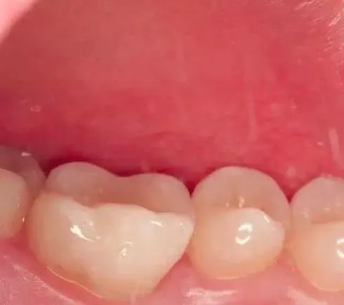 |医生，最里面一颗牙齿烂空了怎么办？有这么多种方法补？价格区别是为什么？