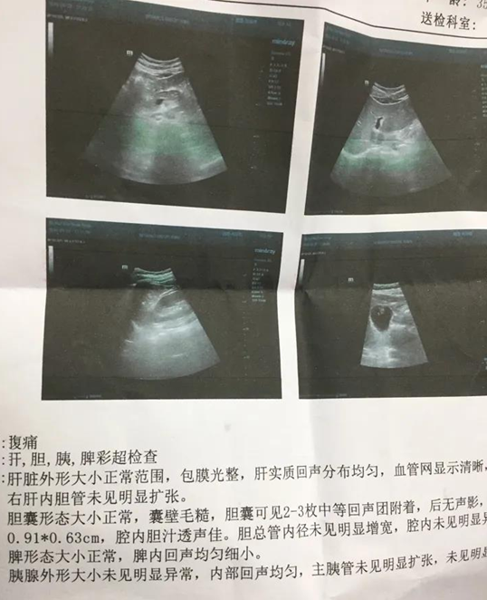 蛋白质|患者来信，案例：消失的胆囊息肉~~