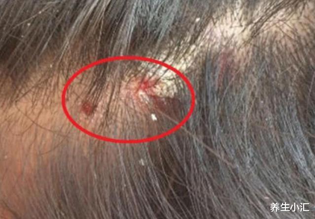 阿司匹林|洗头时加几粒“阿司匹林”，坚持一个月，会有什么结果？不妨试试