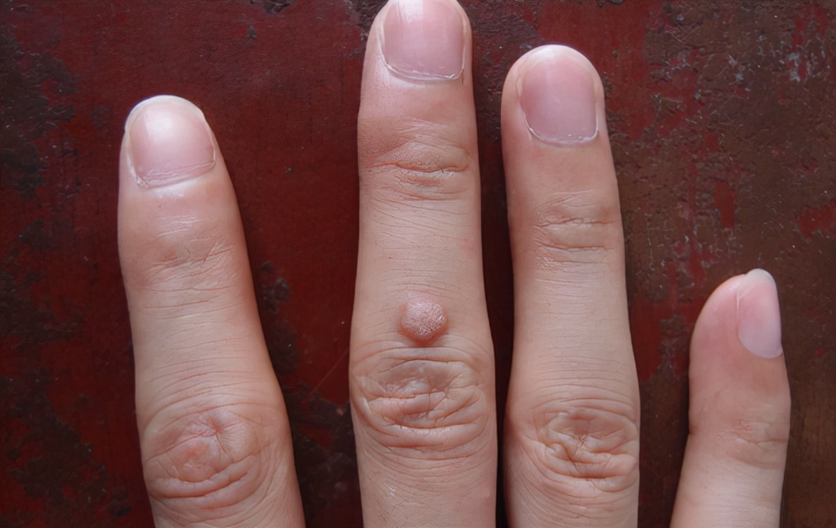 金兰中医学社 26岁女生不幸感染HPV病毒，舌头上长“菜花”，医生摇头：交友不慎