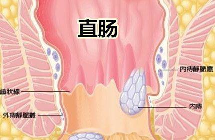 娱乐小龙星|怎么消除庤疮肉球？这份“有痔青年”的痔疮药膏选购指南请收下！