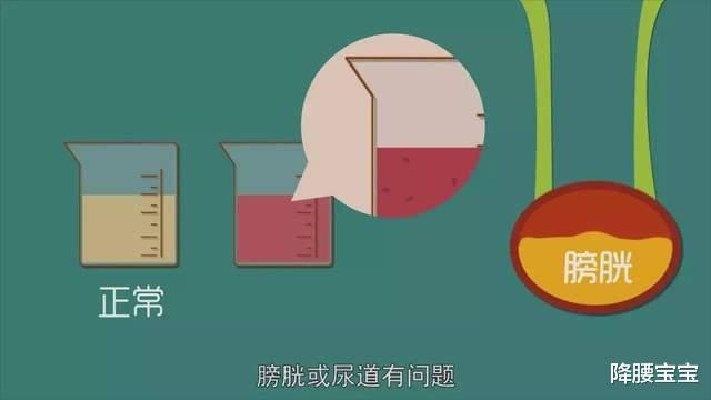 尿路感染|尿中带血是怎么回事?是哪里出了问题?