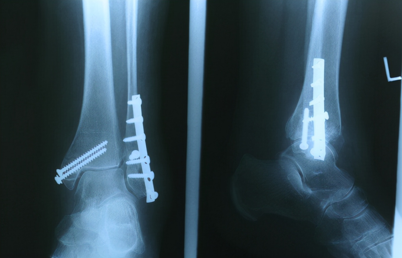 医院|多家医院联合发声:喝一口等于在骨头上“钻孔”,常喝等于自残,快戒掉