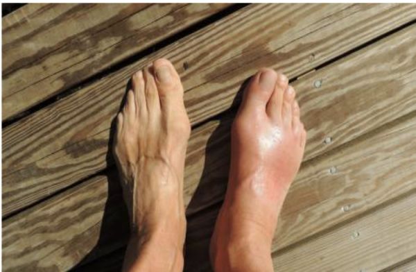 痛风|吃一口相当于一盘海鲜，建议厨房里撤下它，不然痛风患者越吃尿酸越高