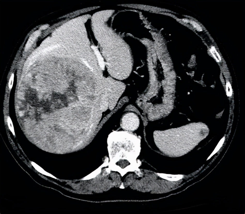 咳嗽|55岁突然发胖，医生却说是水肿？4种常见原因，表现各不相同