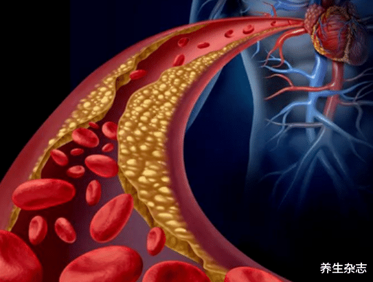 医生|胆固醇“大户”被揪出，吃一口等于10斤肥肉，医生：不想脑梗找上门尽量少吃