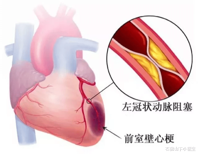 石佛山下小医生|心肌梗死病人都想知道的一个问题：我还能活多久？