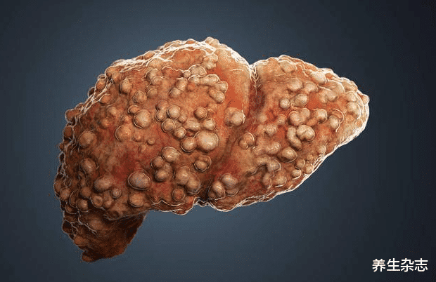 肝癌|一家四口经常腹泻，确诊肝癌，医生：频吃“1种菜”，铁肝也受不了