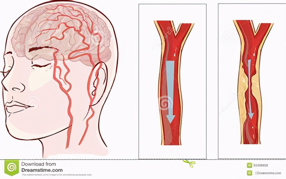 甲状腺结节|66岁还没出现脑梗，是什么水平？医生：恭喜您，已经及格了