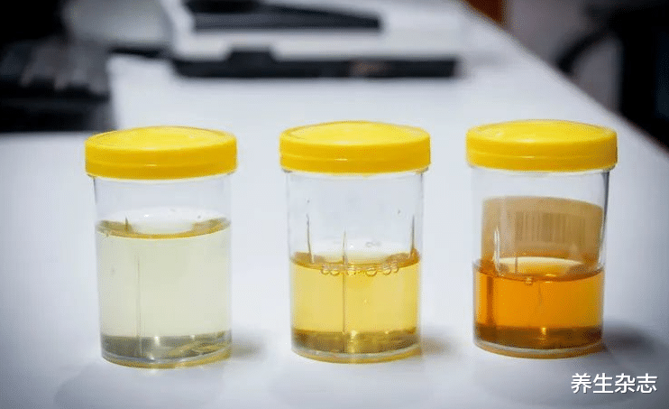 肝癌|身体有“1红1臭2黄”,可能是肝癌前兆,医生:2事常做,肝功可恢复