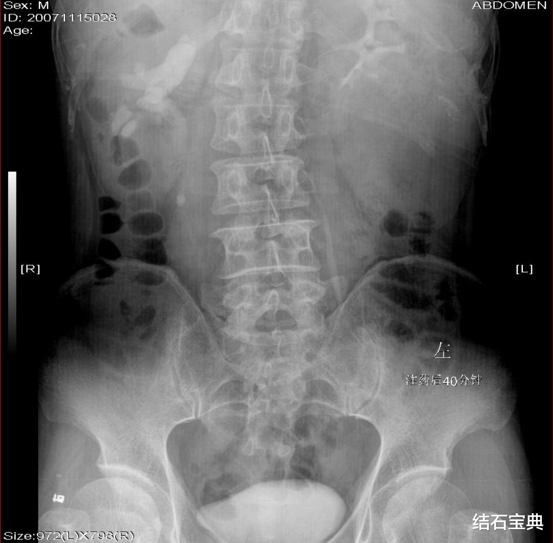 ct检查|怀疑有输尿管结石，如何选择行B超、X线片和CT检查