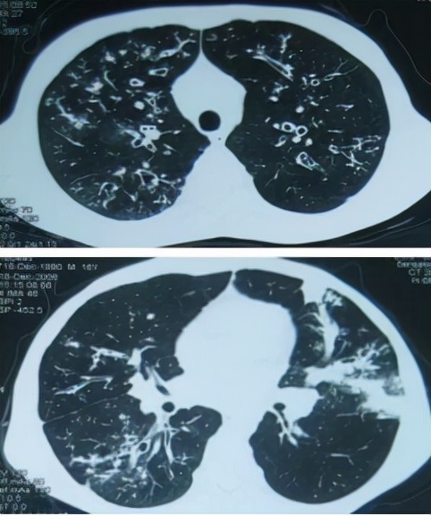 牙齿|27岁小伙反复咳嗽、咳痰4年余,治愈不敢想?如今却成真了