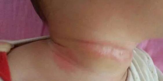 我是妈妈|夏天一到，宝宝就容易“淹脖子、淹大腿”，家长如何做好肌肤护理