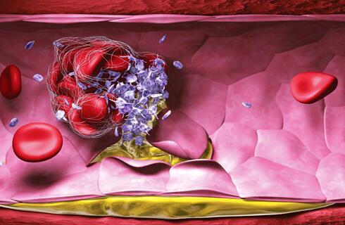 血栓|体内出现血栓时，身体会给出6个求救信号，就看你能否抓住了！