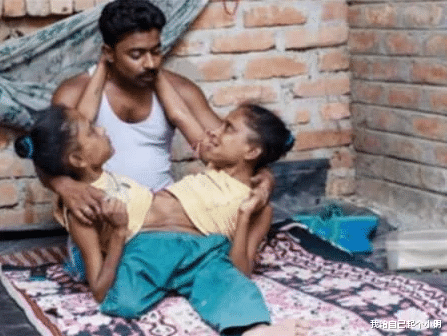 印度連體姐妹共用下肢，嫁給同一位男子，還生下一個孩子-圖4