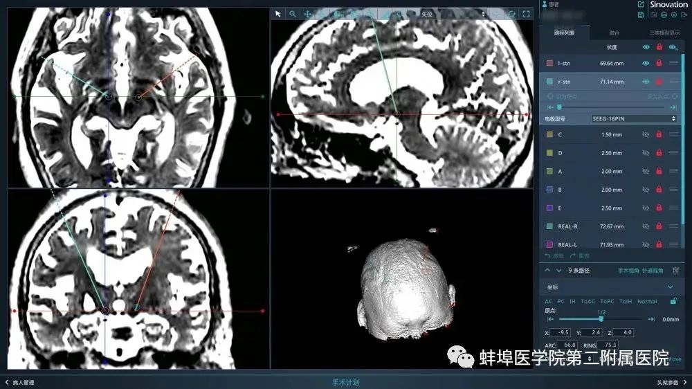 蚌埠广电 蚌埠:在机器人辅助下挑战“生命禁区”