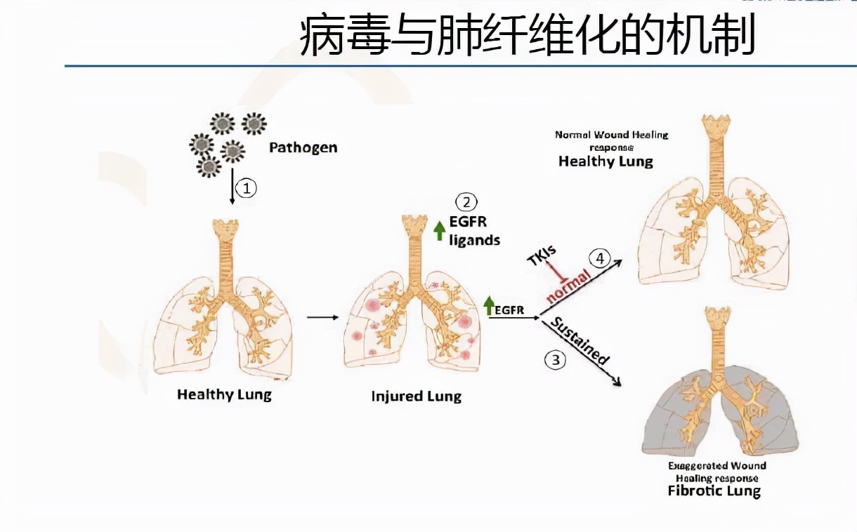 衰老|肺病多是拖出来的!肺早衰3个信号,别轻易忽视!