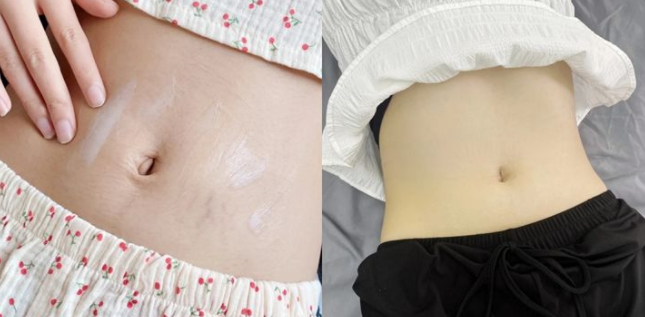 kiki有尚 产后再治疗妊娠纹？晚了！如何预防妊娠纹才有效？宝藏方法在这里