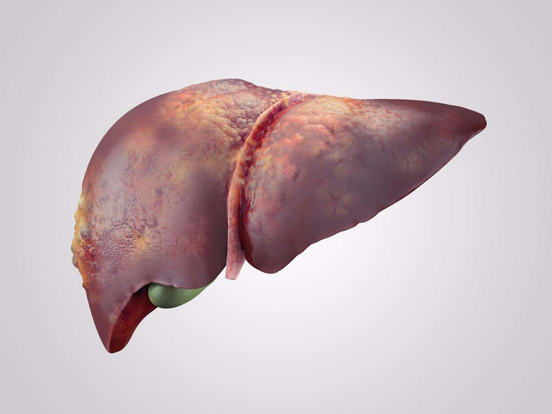 通便|查出脂肪肝还能“逆转”吗？除了减脂，还能依赖4种食物