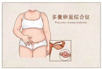 多囊卵巢综合征|多囊也会遗传？得了多囊怎么办？