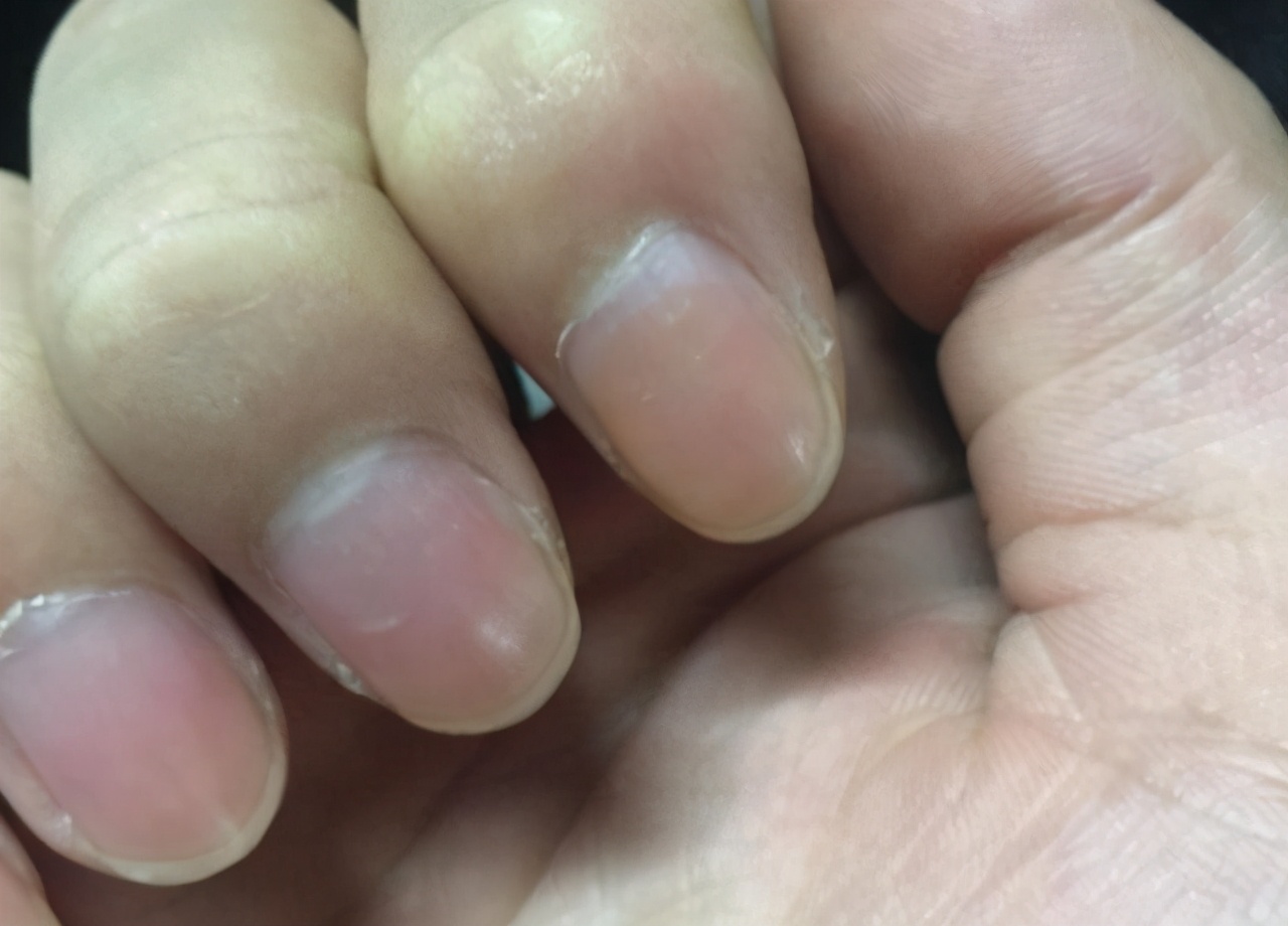 静东堂|体内有癌，手先知？如果手上出现这3种症状，肝癌或已悄然而至
