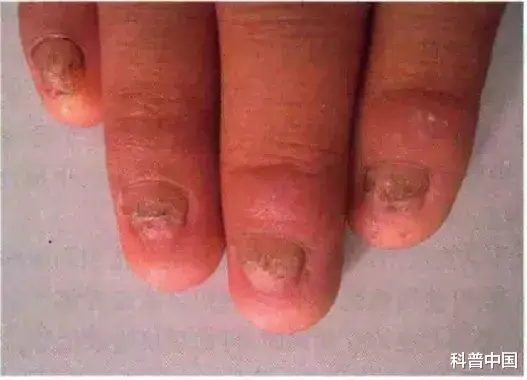 真菌感染|涨知识！原来指甲有斑点、竖纹、变厚竟预示着这些病…