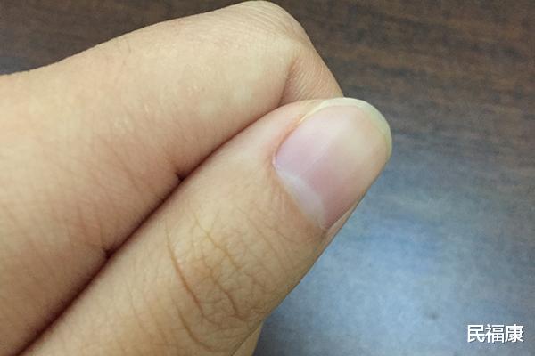 |指甲上的月牙少,代表身体不健康?为什么有的人多,有的人少?