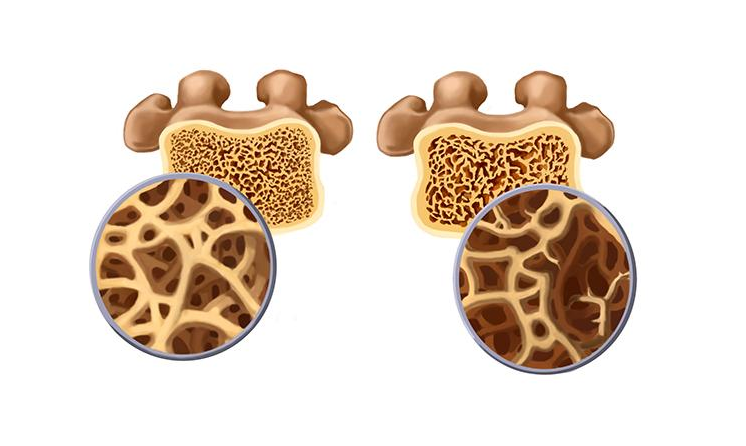 高血压|35女教师养骨半年,骨密度从-2.5到-1.5,医生夸赞:她的好习惯值得借鉴
