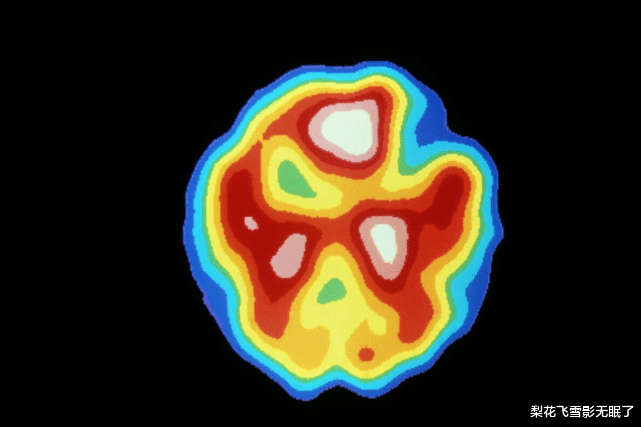 医生|男子头痛以为脑肿瘤，开颅后恶臭液体流出，医生后背冷汗：误诊了