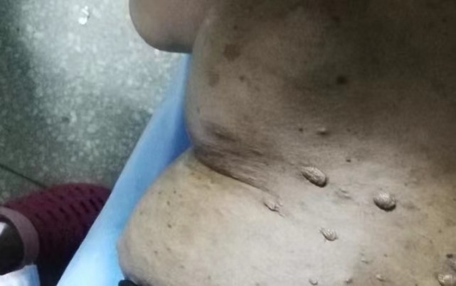 听林医生说 59岁齐阿姨肚子上的“痘痘”，被孙子踩一下，迅速肿大10cm