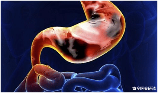 胃癌|胃癌多是拖出来的?消化科医生:腿脚若有3个“异常”,胃或已病得不轻