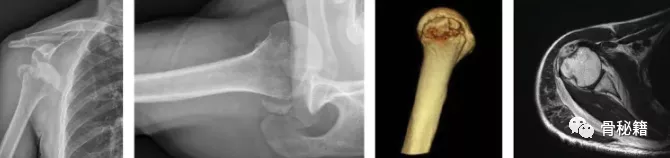 关节脱位|老年肩关节脱位的处理,推荐都看看