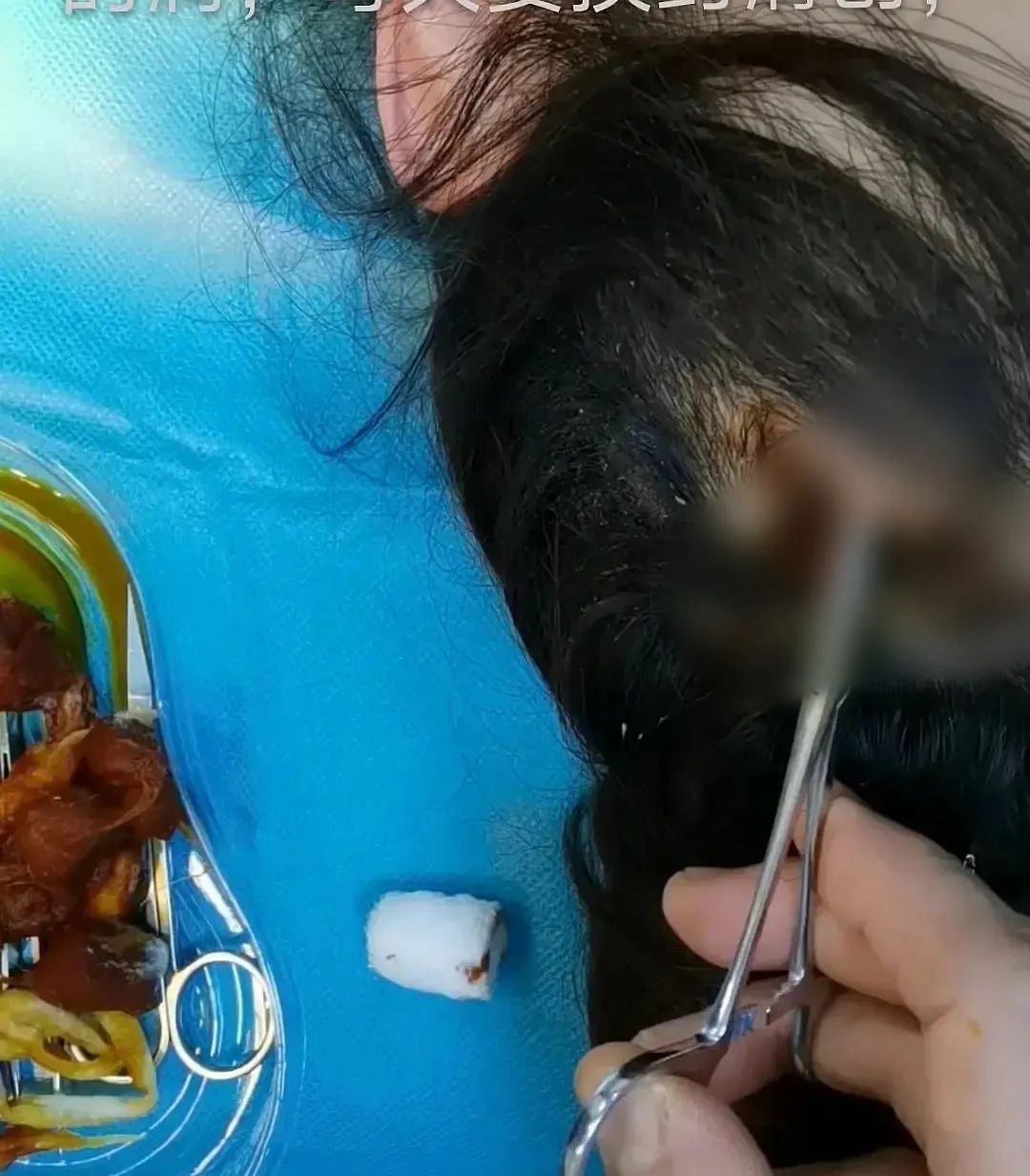 汉方医读 为了变美，真的有人愿意让自己永久残疾。细数那些“畸形”的医美项目。