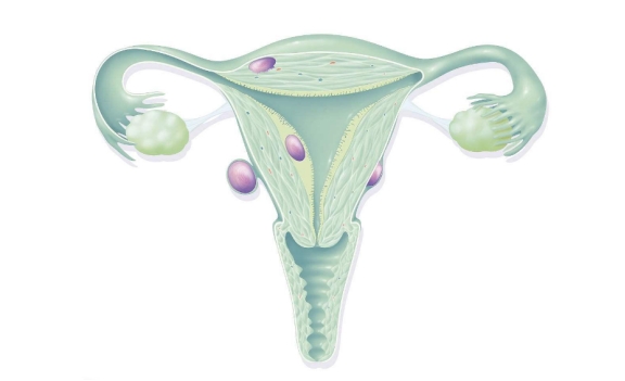 子宫肌瘤|子宫肌瘤不能喝豆浆？72岁医生提醒：若想肌瘤消散，少吃2种食物