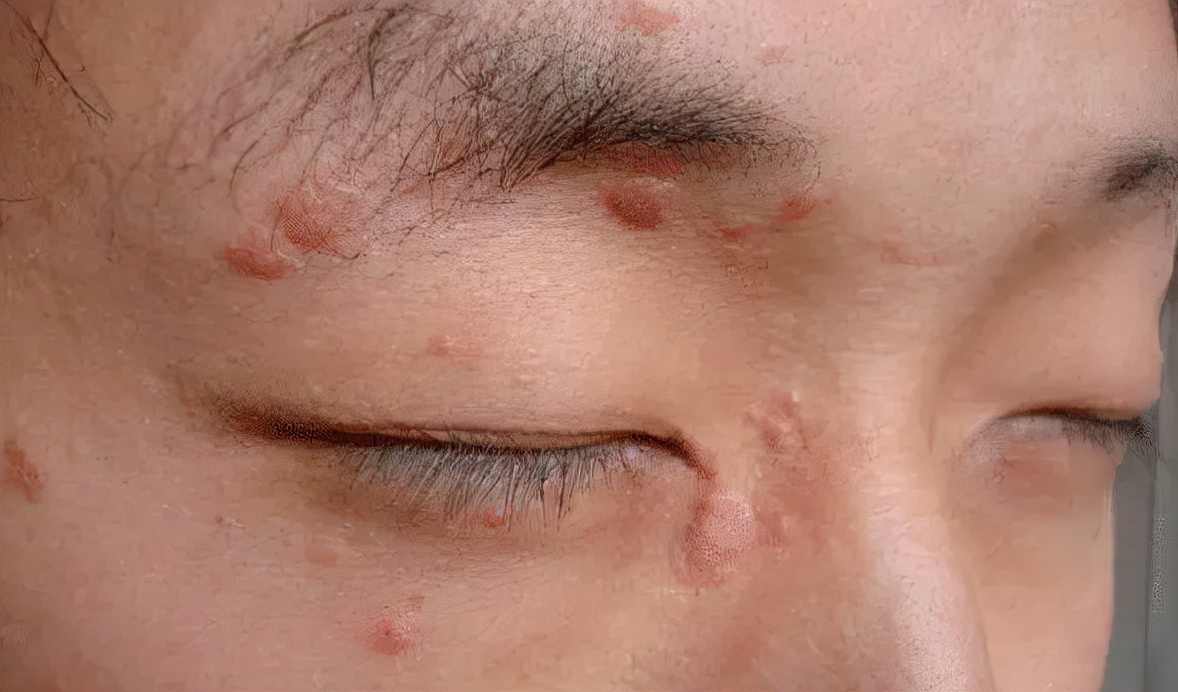 医生|00后小伙染HPV,脸上长满“肉芽”,医生:他女朋友这次闯大祸了