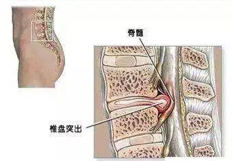 峰哥说表|一个小土方，消除腰间盘突出很简单，一用一个好！