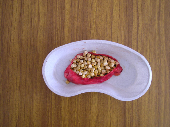 膀胱结石|你永远都不知道，结石会从哪个部位长出来