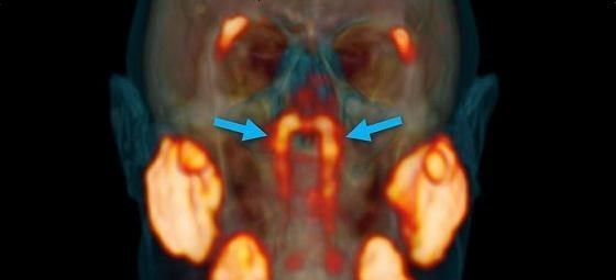 癌细胞 科学家在人的喉咙深处，发现了一个新的器官，人体还要多少秘密