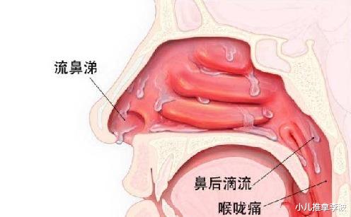 咳嗽|中医儿科李波：什么是儿童上气道咳嗽综合征？有啥表现，如何治疗