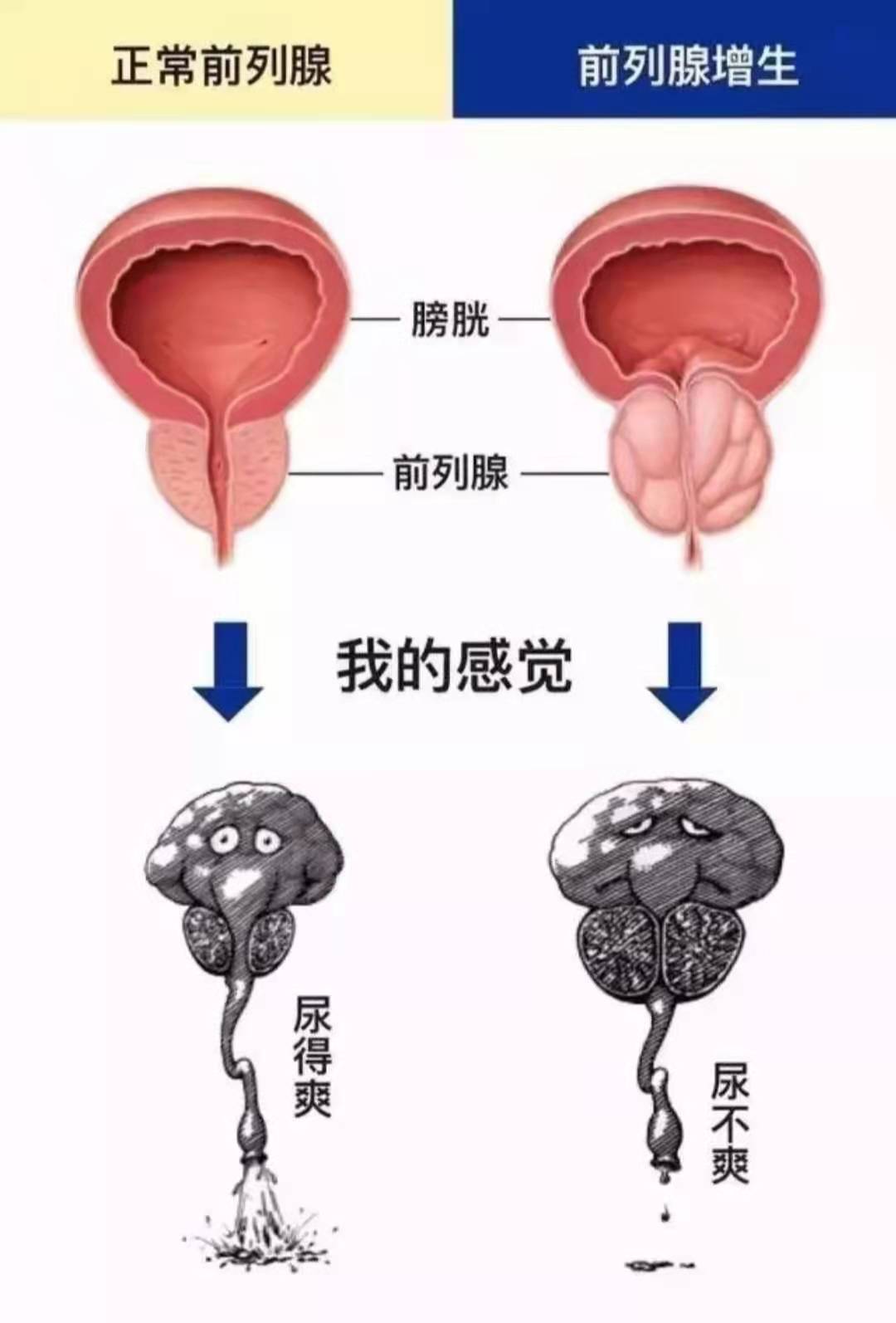 前列腺增生|到了年紀，前列腺為什么會增生？